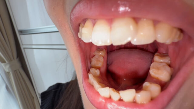 【個人撮影】原美織の舌ブラシで「汚舌苔」採取