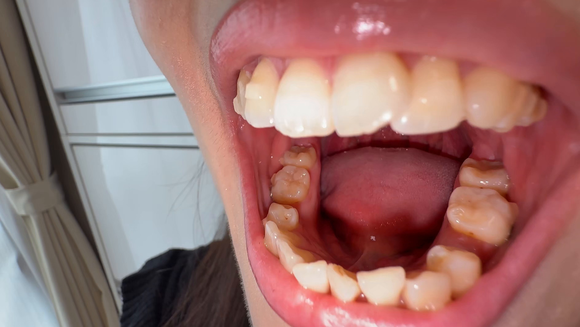 【個人撮影】原美織の舌ブラシで「汚舌苔」採取